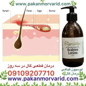 درمان قطعی گال