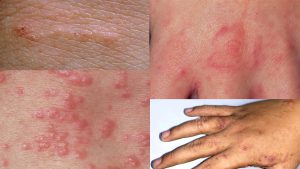 سم گال و درمان قطعی گال