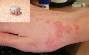 درمان گال با سرکه