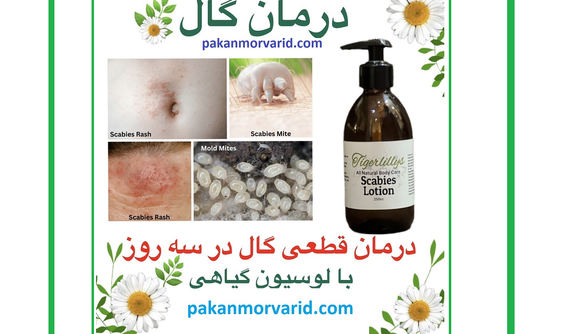 درمان گال با نمک