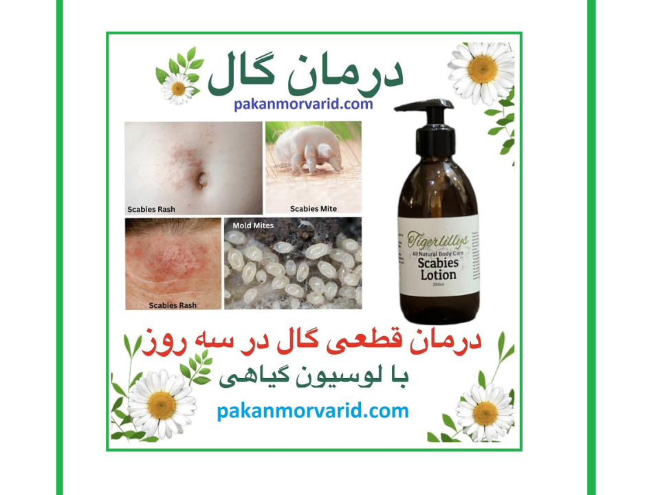 درمان گال با نمک