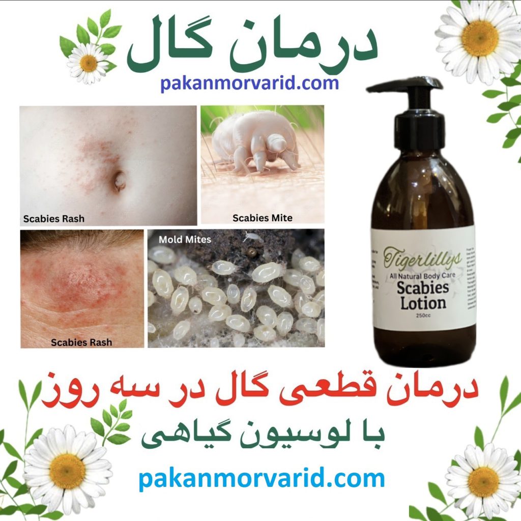 درمان گال با نمک