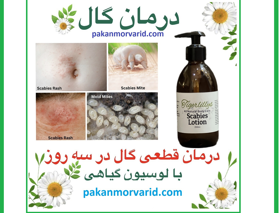 درمان گال با آمپول